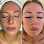 Microdermabrasion