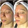 Microdermabrasion