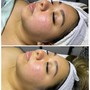 Dermaplaning