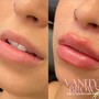 Russian Technique Lip Filler