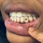 60 Min Teeth Whitening and 1 Gem SPECIAL*