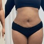 Skinny Lipo Shots