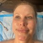 MicroNeedling