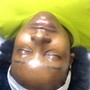 Acne Facial