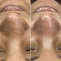 High Frequency Facial Treatment