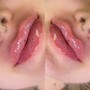 Lip infusions 1ml