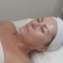 Microdermabrasion