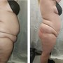 3 Laser Lipo or 3 Fat Cavitation