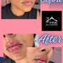 1ML Lip Filler