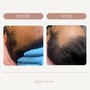 Scalp Micropigmentation