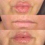 1ML Needleless Lip Fillers