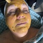 Chemical peel package