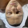 Acne facial