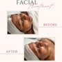 Facial tightening