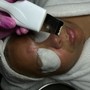 Hydra Facial