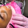 Back Facial with Microdermabrasion