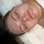 Acne Facial