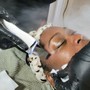 MicroNeedling