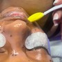 Microdermabrasion