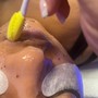 Microdermabrasion