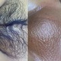 Microdermabrasion