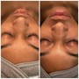 Rejuvenation Facial