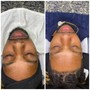 Rejuvenation Facial