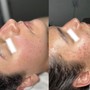 Microneedling Face