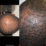 Scalp Treatment