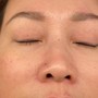 Microdermabrasion