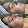 Hybrid Facial with Chemical peel