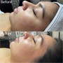 Intermediate level Facial w/ Chemical Peel