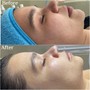 Facial with Dermaplane