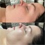 Hybrid Facial with Chemical peel