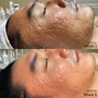 Korean ‘Active Enzyme’ Facial