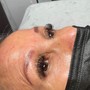 Microdermabrasion