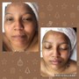 Acne Facial