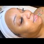 Acne Treatment Facial