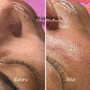 Microdermabrasion