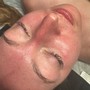 Clinical Acne Facial