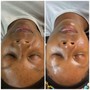 Blemish AND Balance Facial