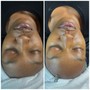 Deep Chemical peel