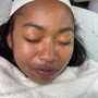 Acne Facial