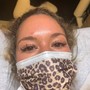 Microdermabrasion