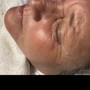 Microdermabrasion Facial + LED Therapy