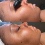 Dermaplaning