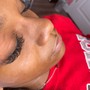 Microdermabrasion