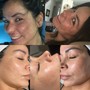 Dermaplaning with a super facial Peel