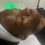 Microdermabrasion