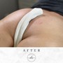 Buttock’s Chemical Peel